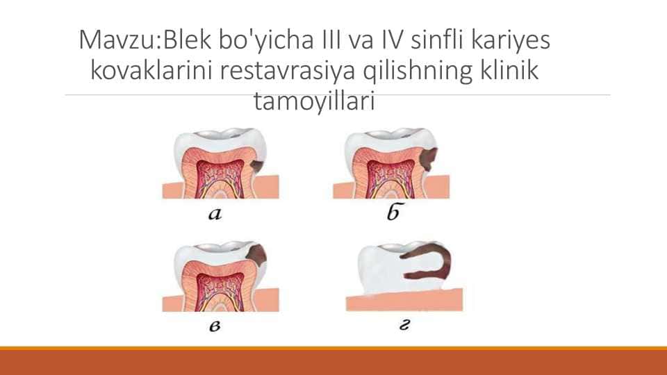 Mavzu:Blek bo'yicha III va IV sinfli kariyes kovaklarini restavrasiya qilishning klinik tamoyillari