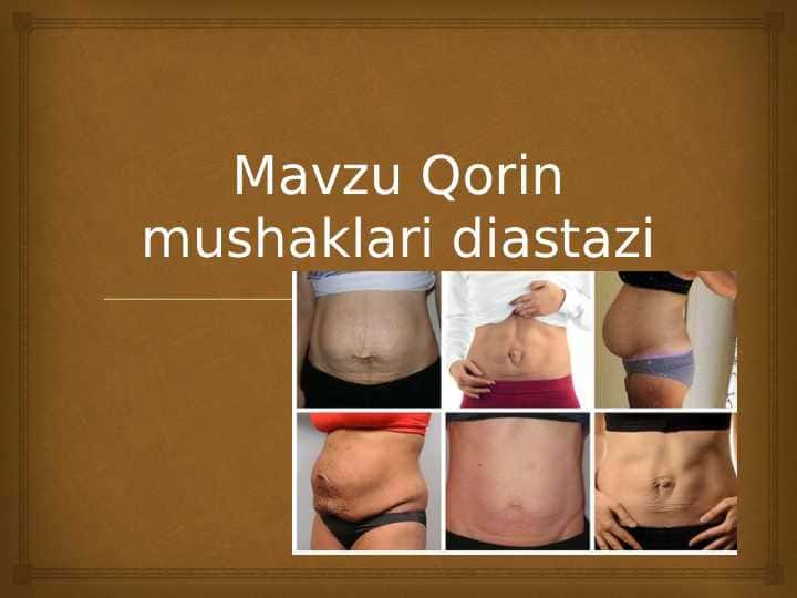 Qorin mushaklari diastazi