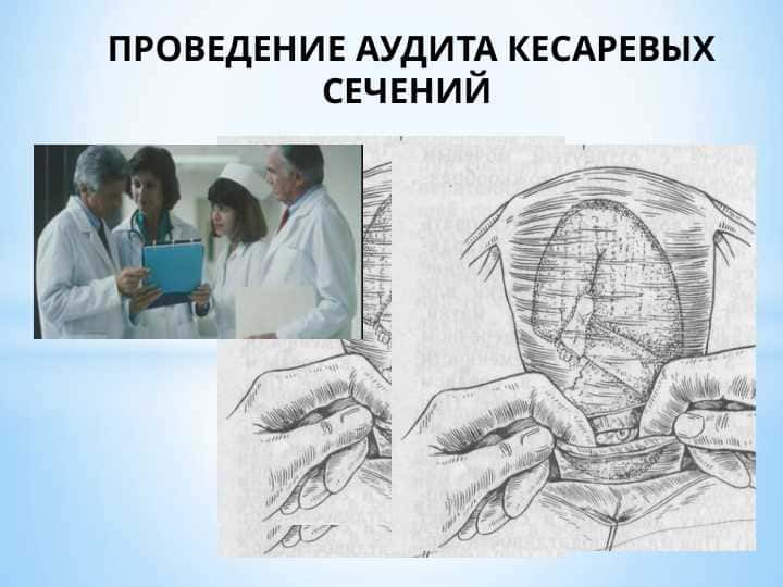 ПРОВЕДЕНИЕ АУДИТА КЕСАРЕВЫХ СЕЧЕНИЙ