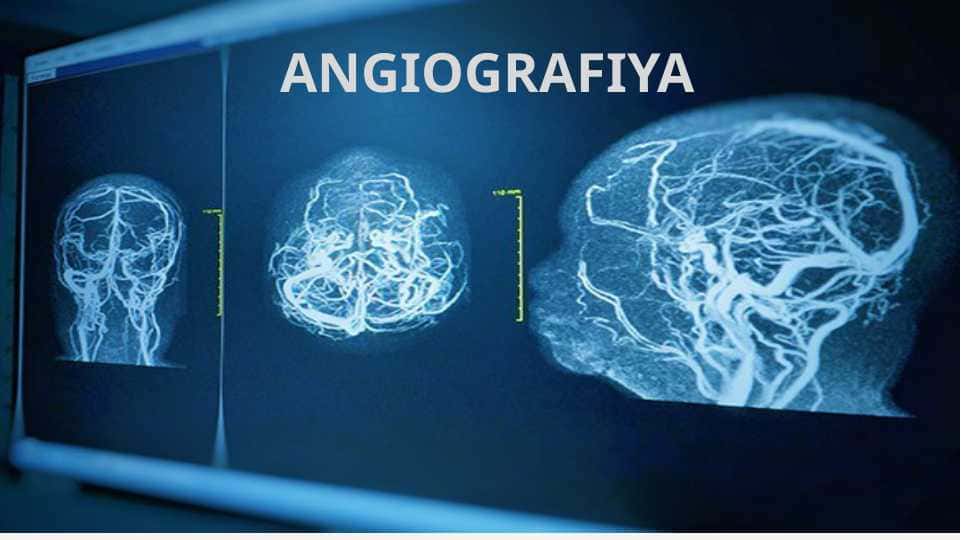 ANGIOGRAFIYA 