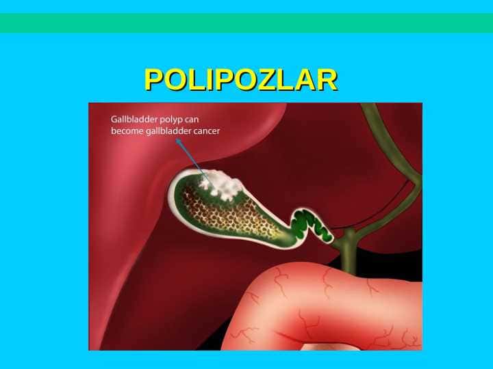 POLIPOZLAR
