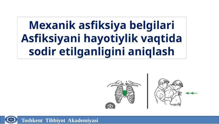 Mexanik asfiksiya belgilari Asfiksiyani hayotiylik vaqtida sodir etilganligini aniqlash