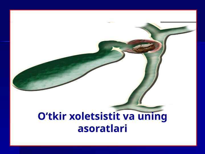 O‘tkir xoletsistit va uning asoratlari