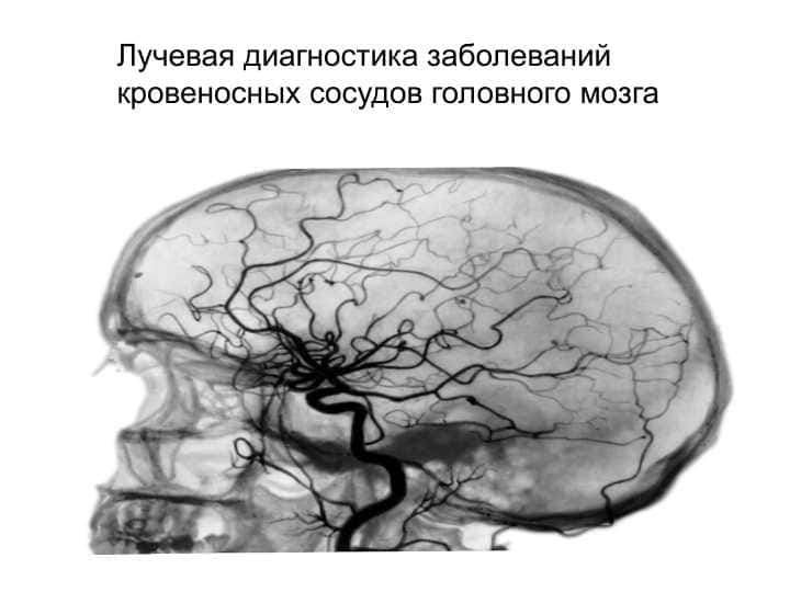 Лучевая диагностика заболеваний кровеносных сосудов головного мозга
