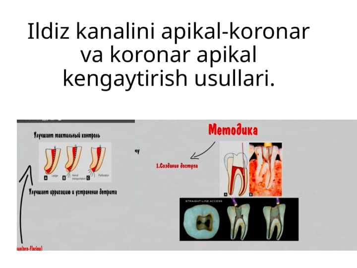 Ildiz kanalini apikal-koronar va koronar apikal kengaytirish usullari.