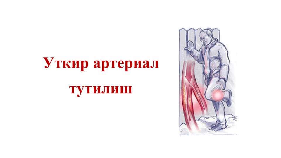 Уткир артериал тутилиш