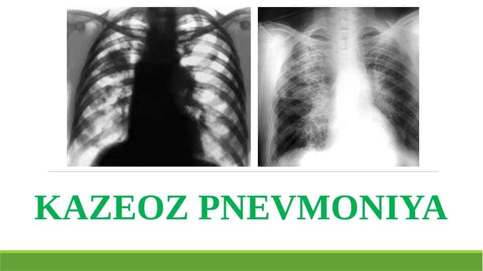 KAZEOZ PNEVMONIYA