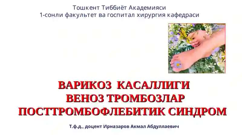 ВАРИКОЗ КАСАЛЛИГИ