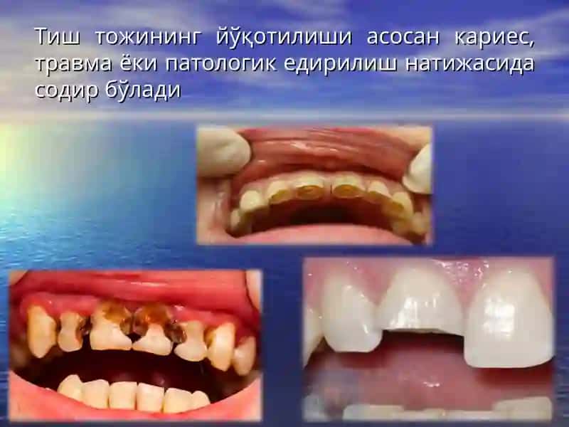 Тиш тож қисмининг қисман ва тўлиқ йўқотилганда ўзакли конструкциялар билан тиклаш.