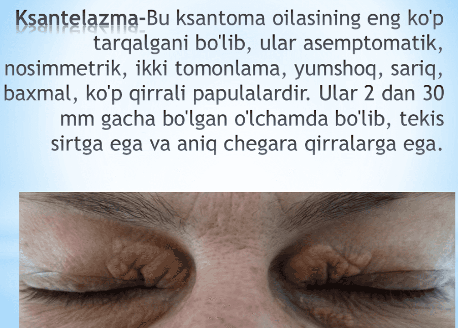 Ksantelazma.Lipoma.Gigroma