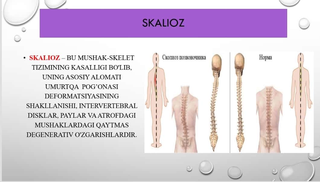 Skalioz kasalligi, tashxislash va kasallikni davolash usullari
