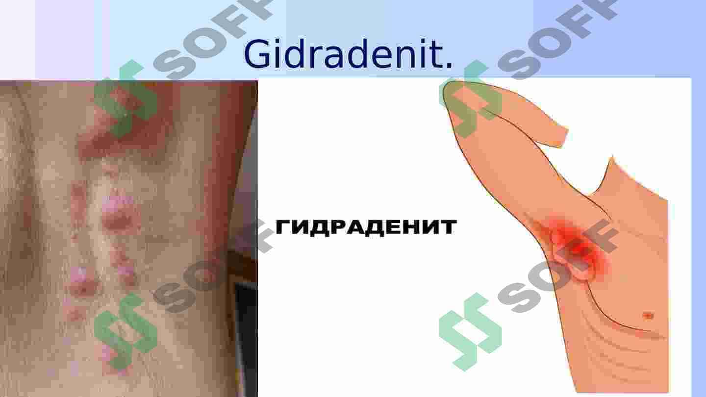 Gidradenit, mastit, paroproktit, erizepiloid etiologiyasi va patogenezi.