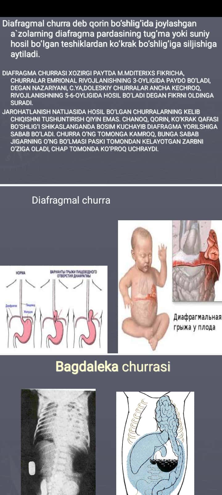 Diafragmal churralar