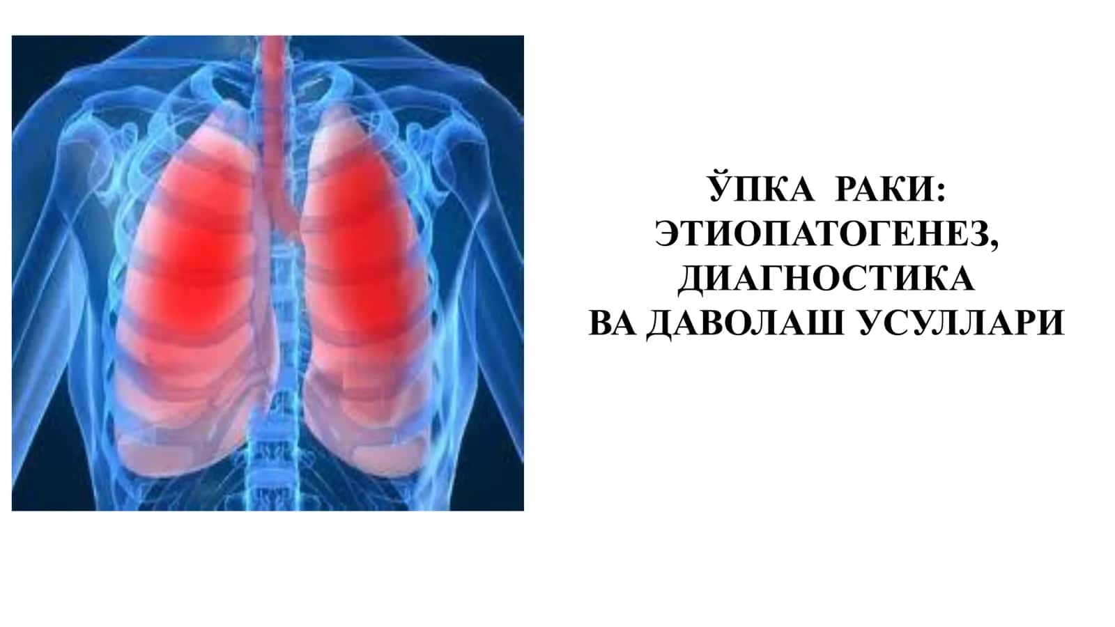ЎПКА РАКИ: ЭТИОПАТОГЕНЕЗ, ДИАГНОСТИКА ВА ДАВОЛАШ УСУЛЛАРИ