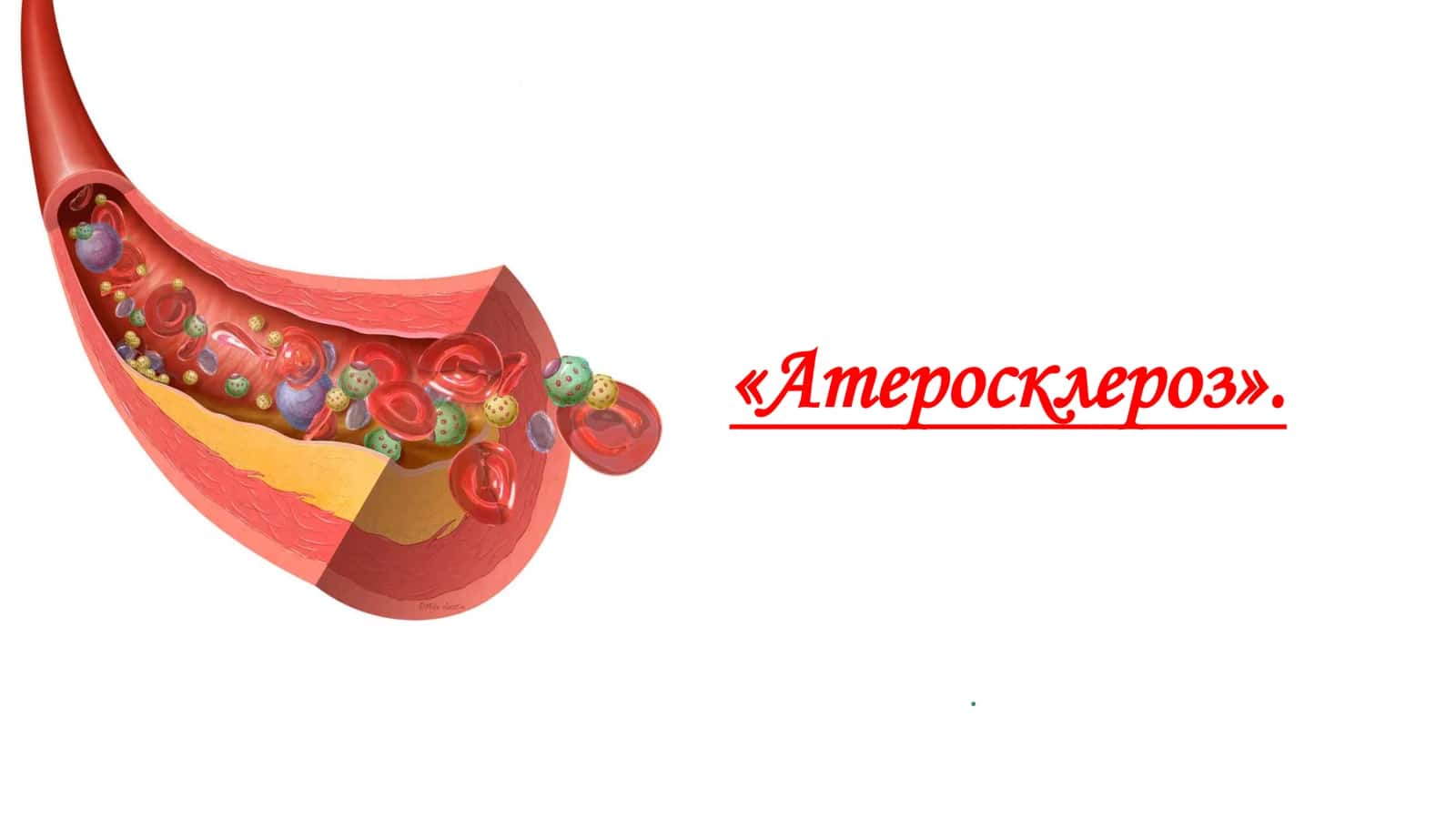 Атеросклероз