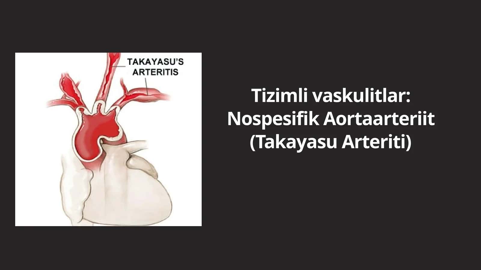 Takayasu Arteriti