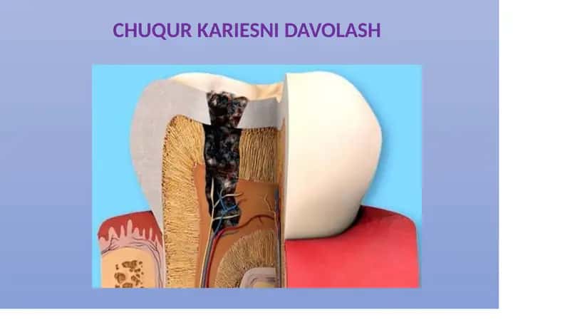 CHUQUR KARIESNI DAVOLASH