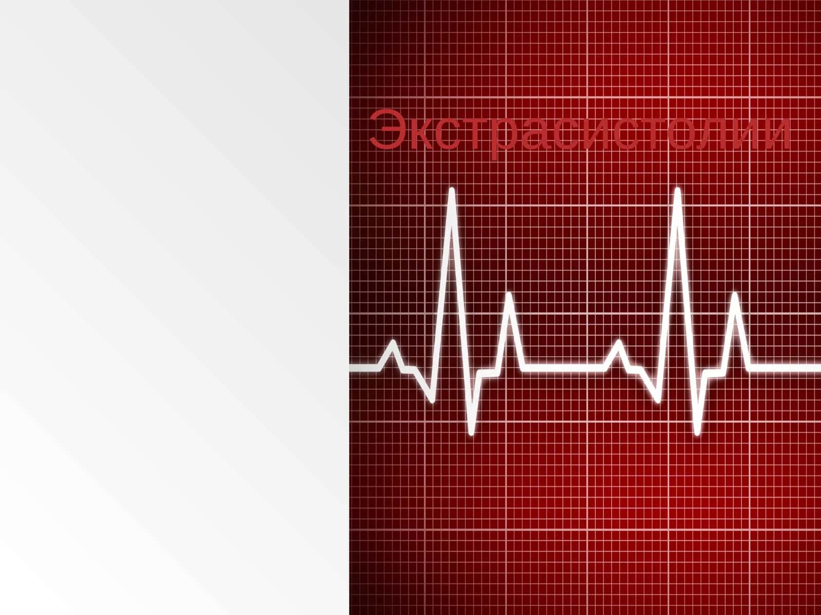 Экстрасистолии