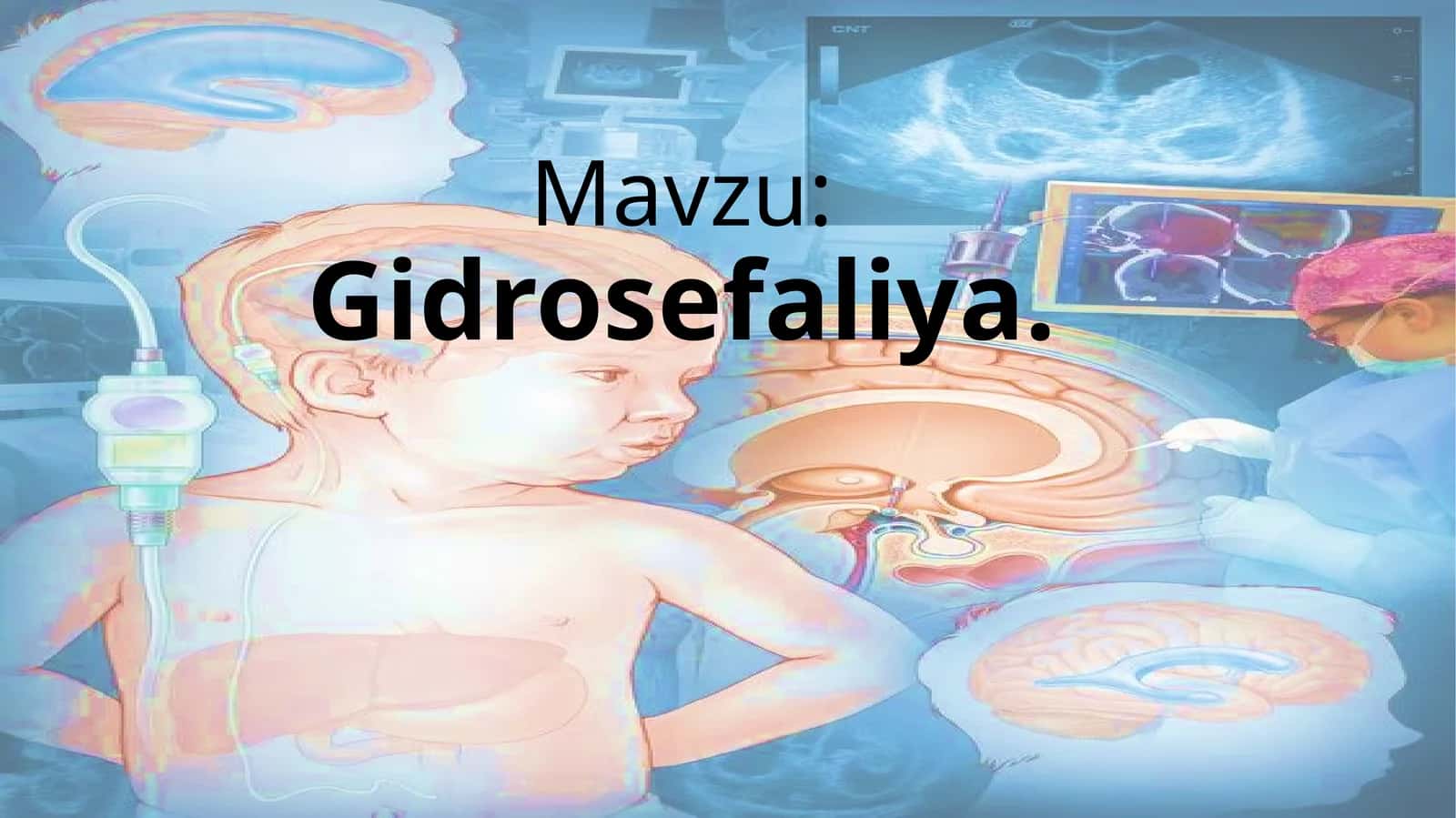 Gidrosefaliya