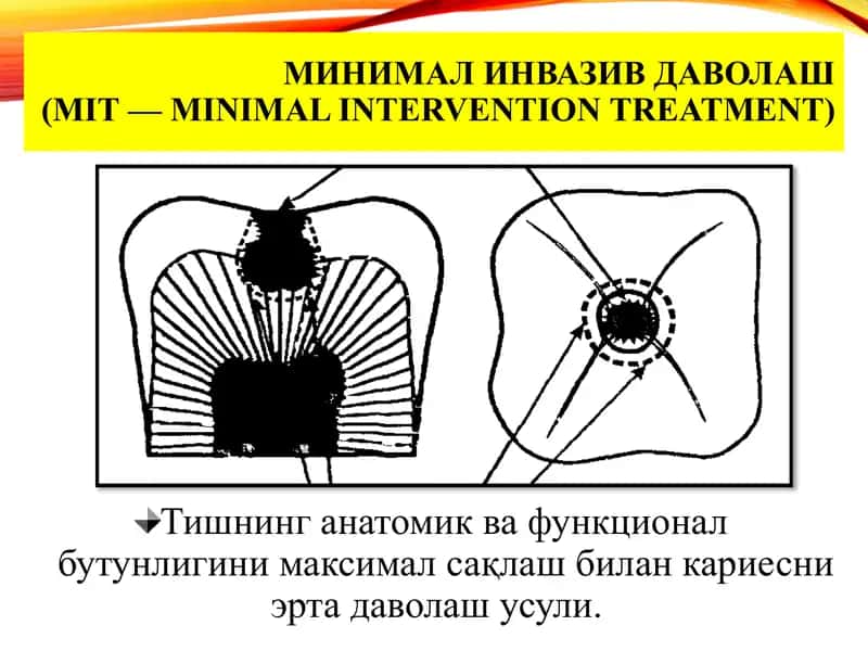 МИНИМАЛ ИНВАЗИВ ДАВОЛАШ(MIT—minimalinterventiontreatment)