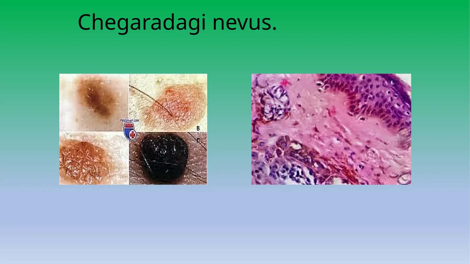 Chegaradagi nevus