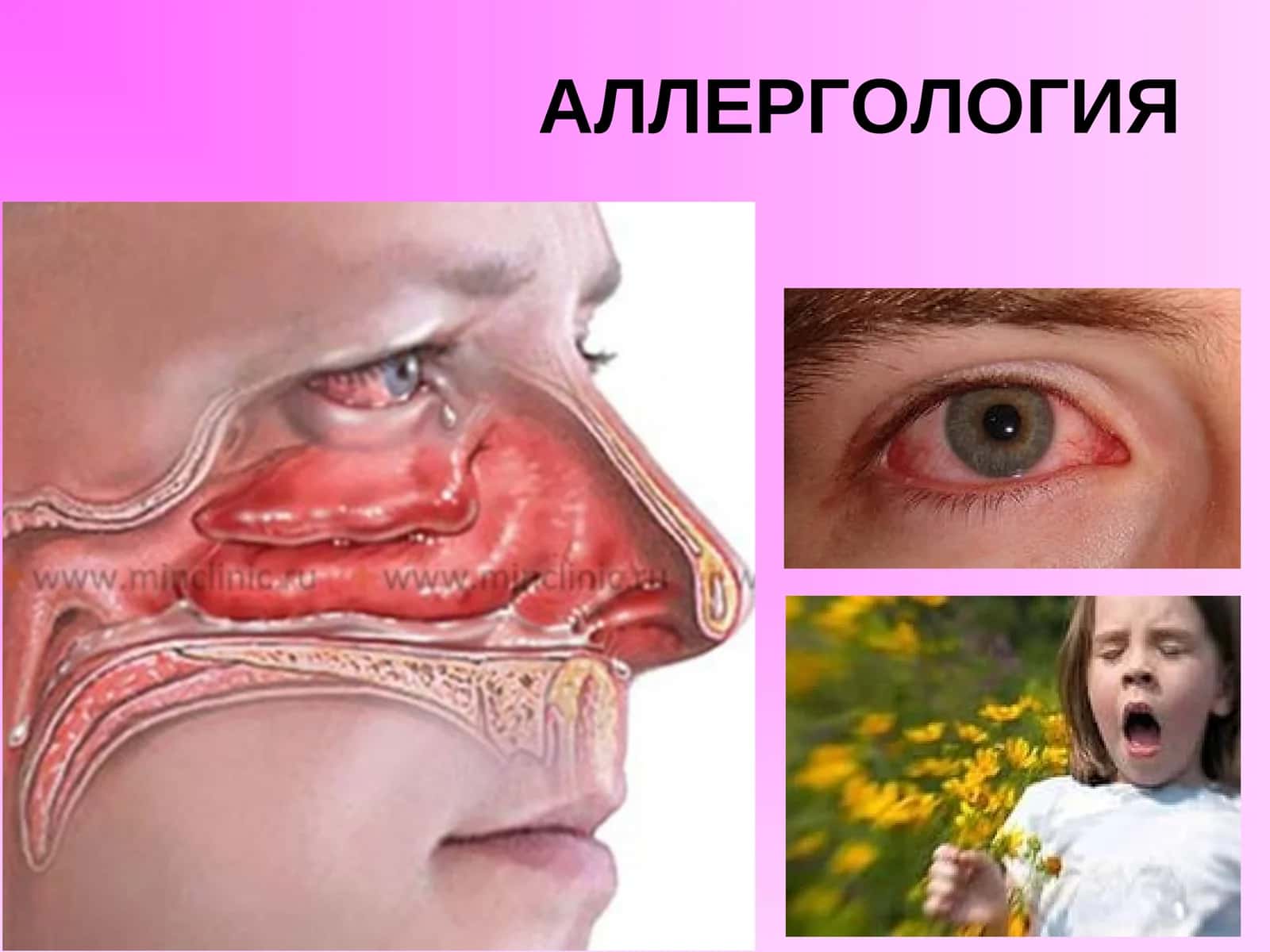 АЛЛЕРГОЛОГИЯ