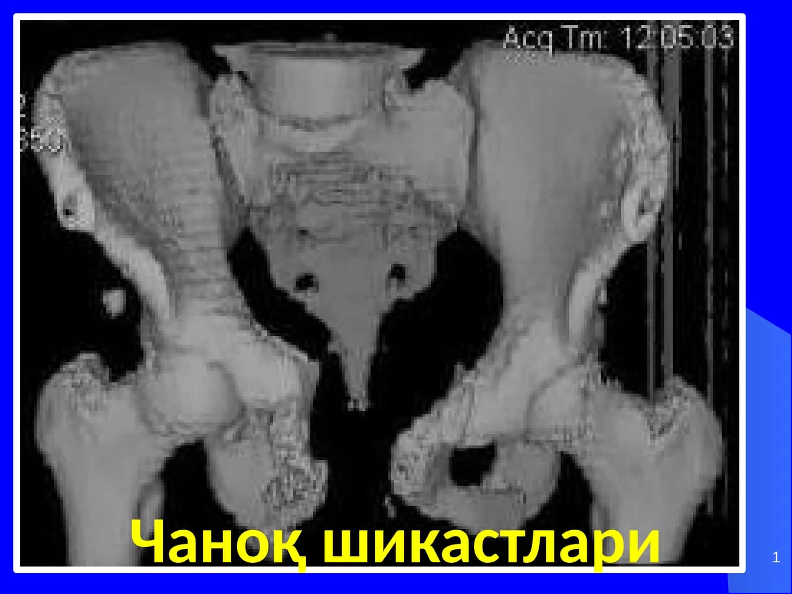 Чаноқ шикастлари