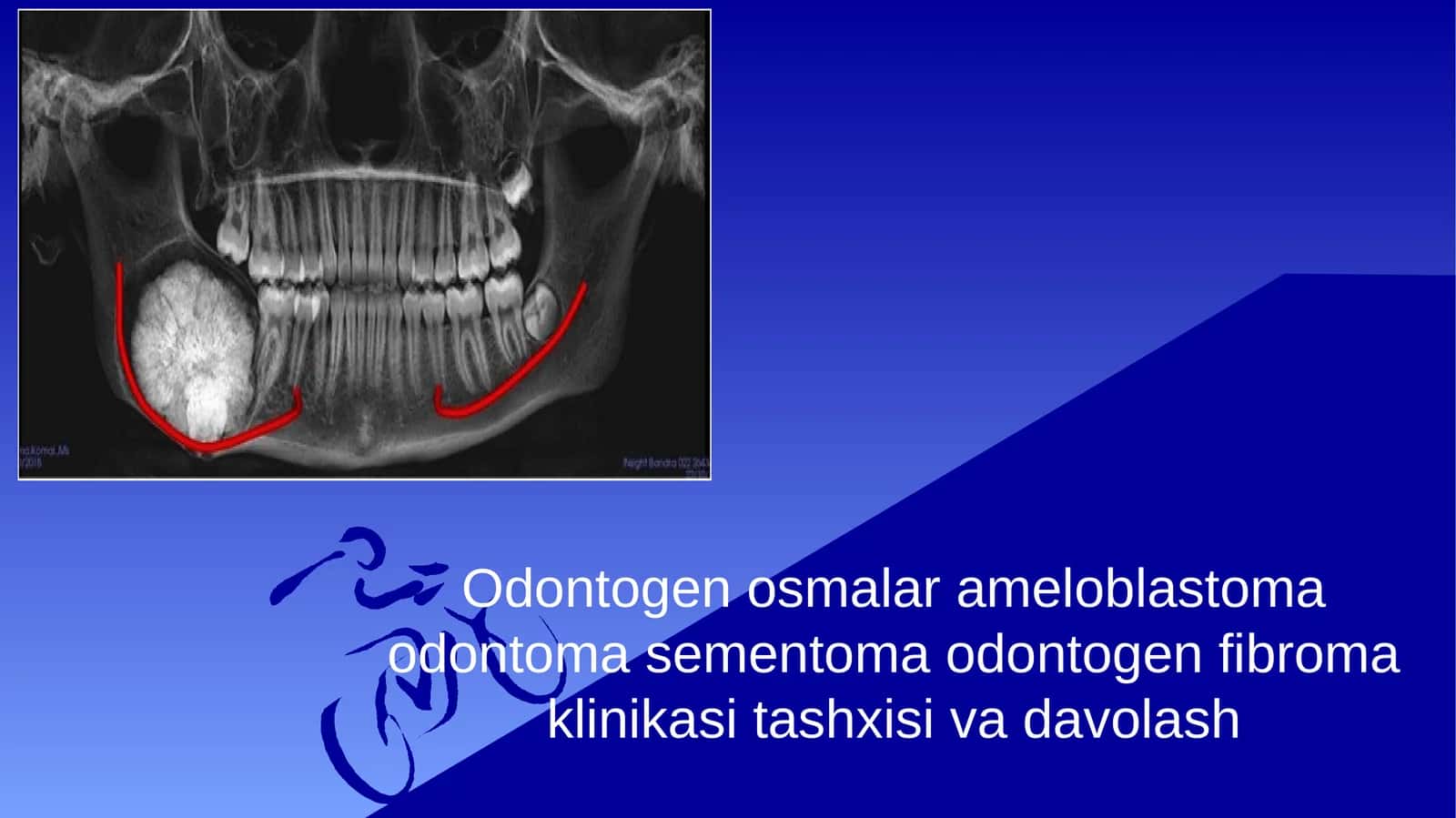 Odontogen osmalar ameloblastoma odontoma sementoma odontogen fibroma klinikasi tashxisi va davolash