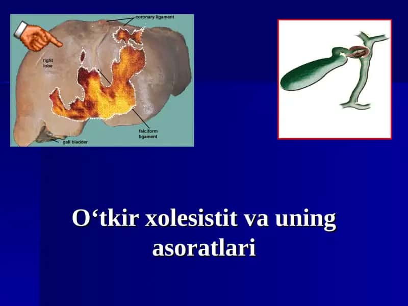 O‘tkir xolesistit va uning asoratlari