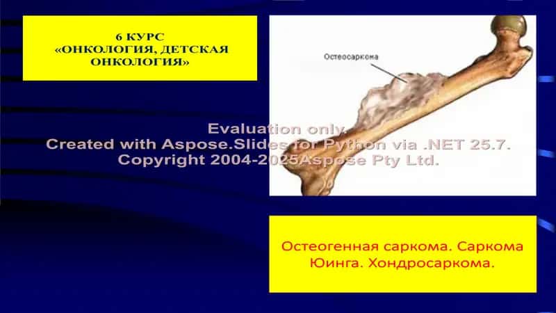 Злокачественные опухоли костей (rus)