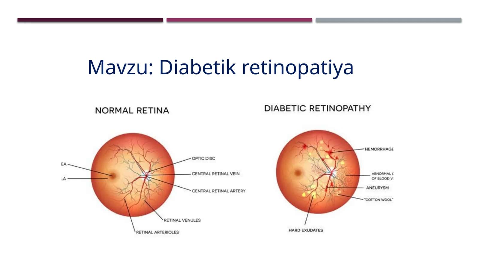 Diabetik retinopatiya