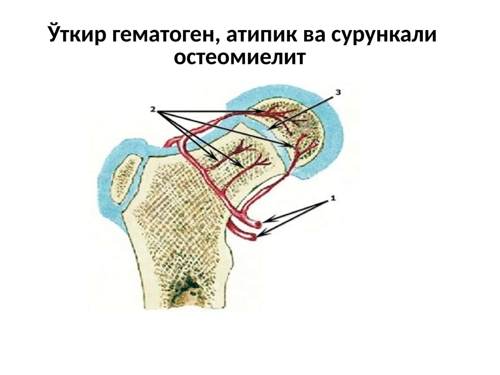 Уткир гематоген, атипик ва сурункали остеомиелитv - osteomiyelit