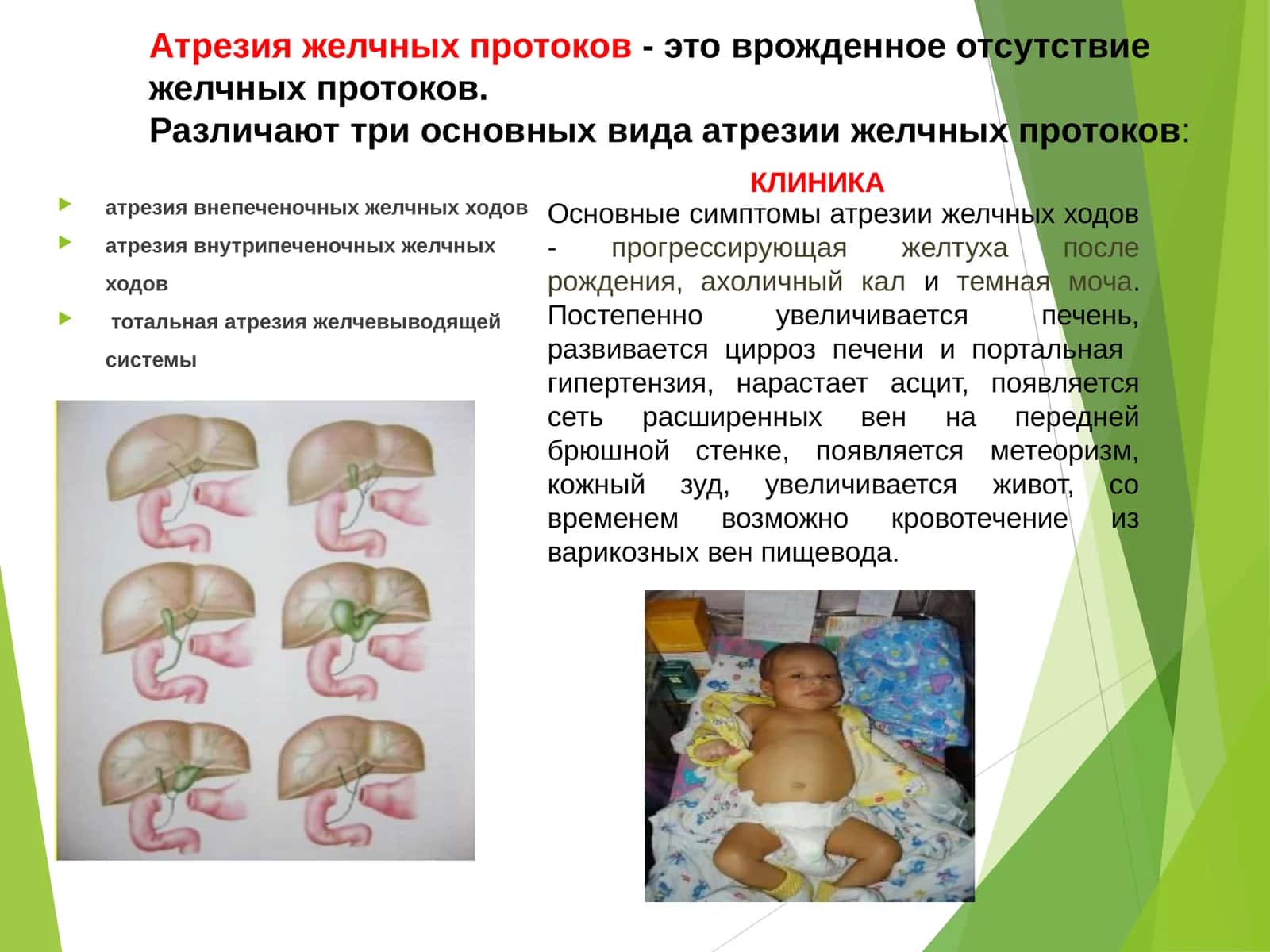 Атрезия желчных протоков