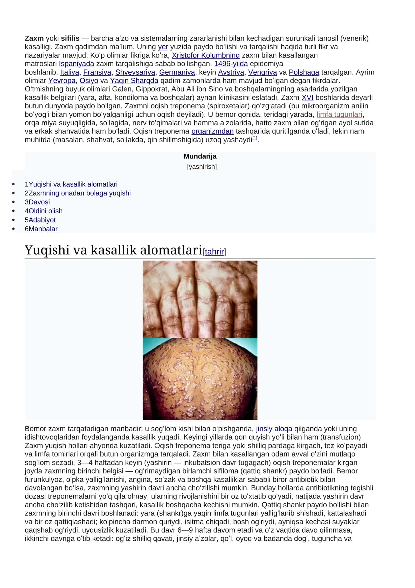 Zaxm kasalligi