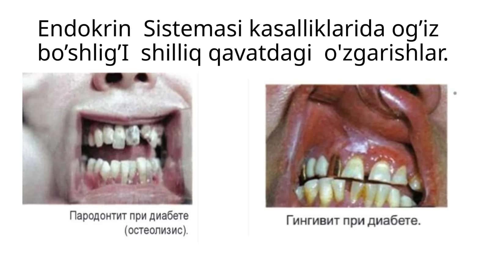 Endokrin Sistemasi kasalliklarida og’iz bo’shlig’I shilliq qavatdagi o'zgarishlar