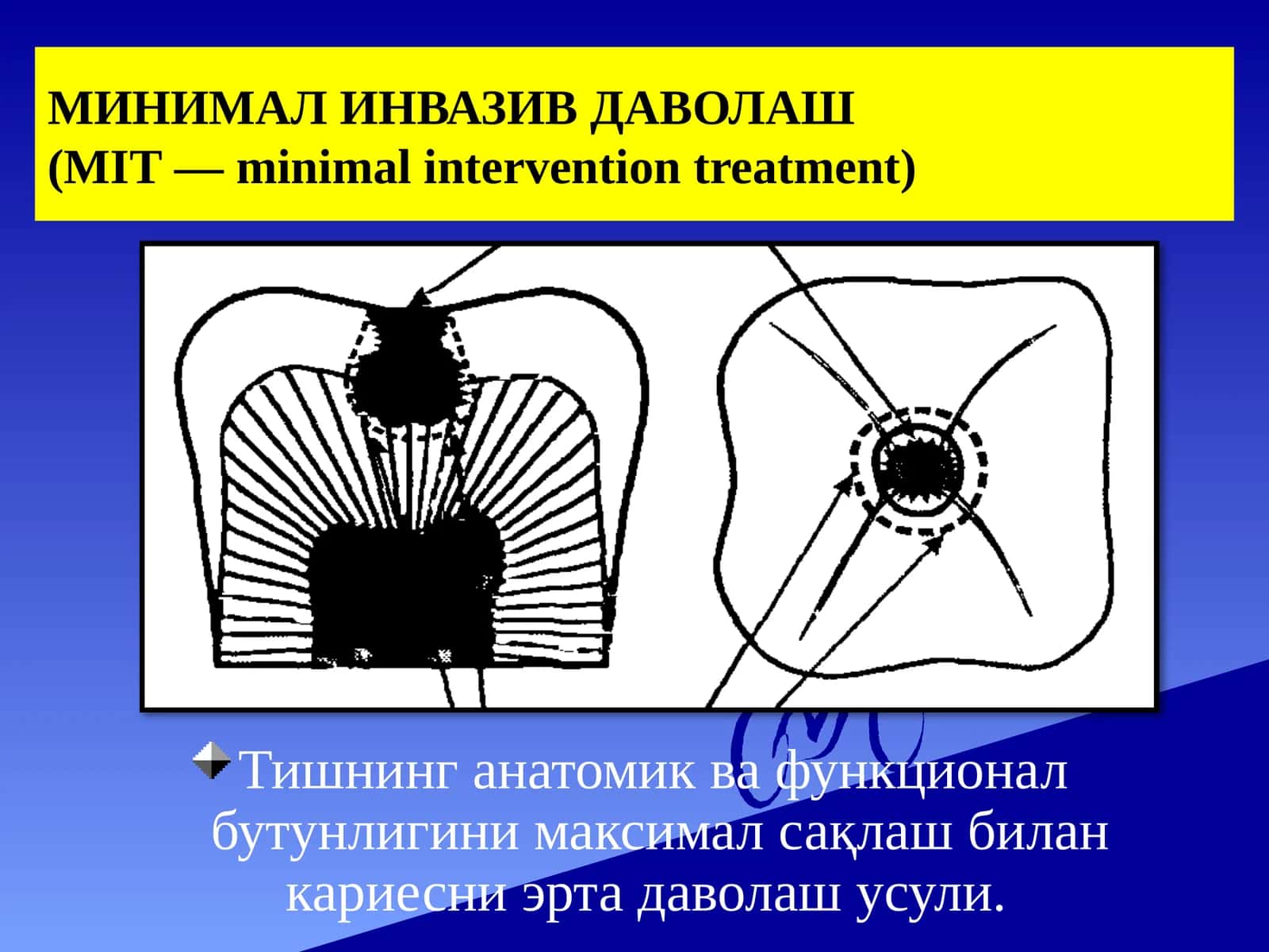 МИНИМАЛИНВАЗИВ ДАВОЛАШ(MIT—minimalinterventiontreatment)