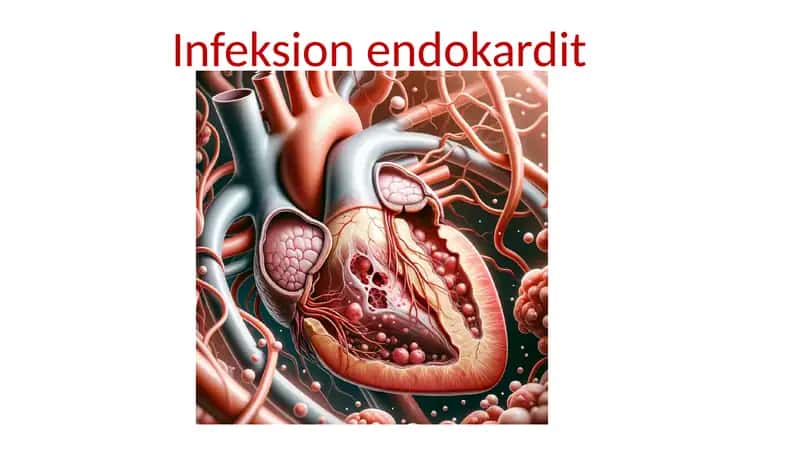 Infeksion endokardit