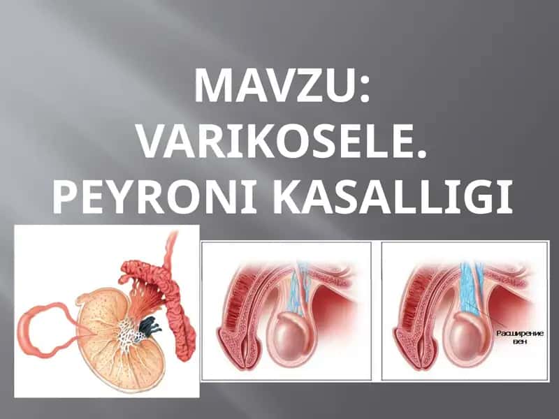 Varikosele