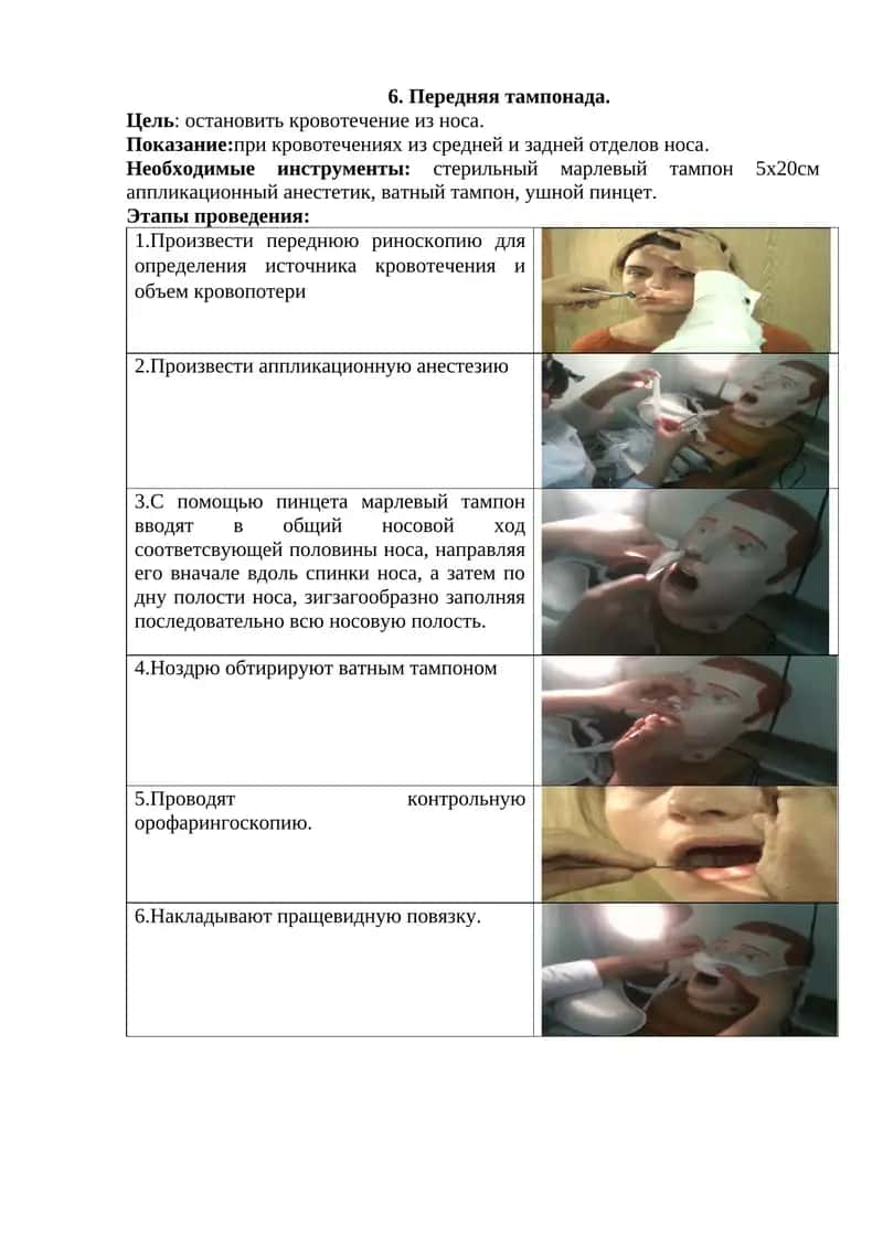 Передняя тампонада