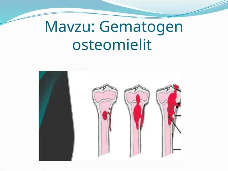 Gematogen osteomielit