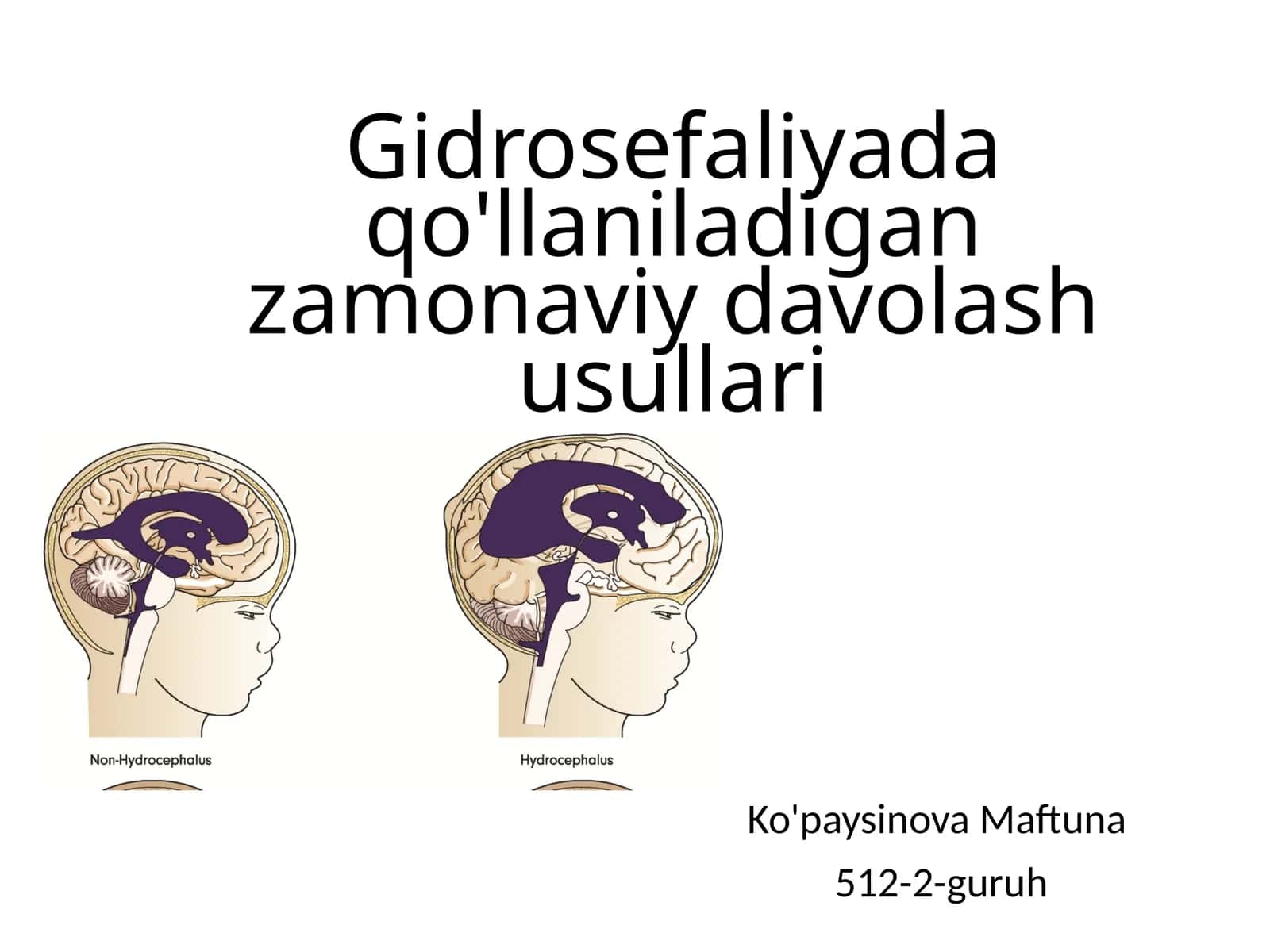 Gidrosefaliyada qo'llaniladigan zamonaviy davolash usullari