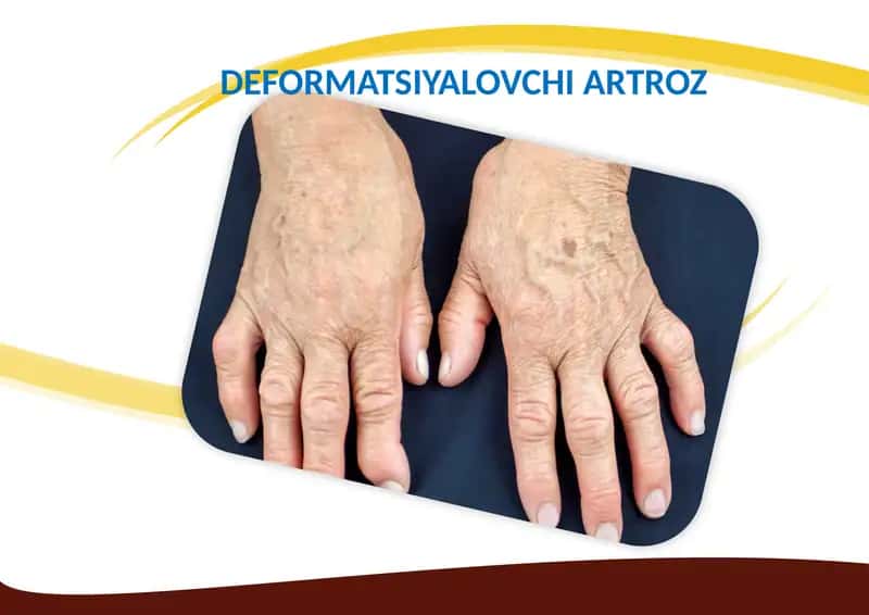 Deformatsiyalovchi Artroz