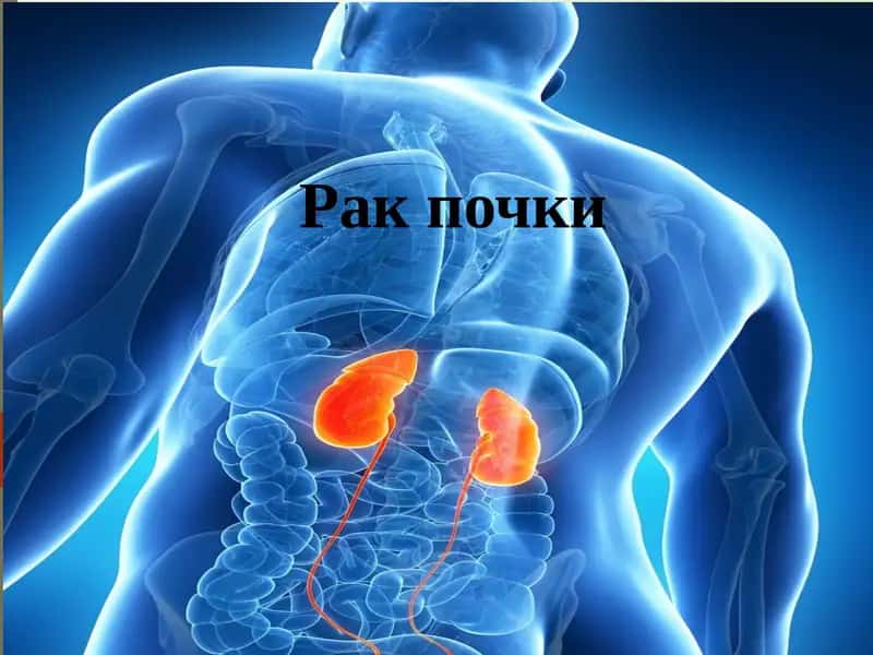Рак почки