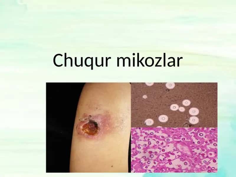 Chuqur mikozlar