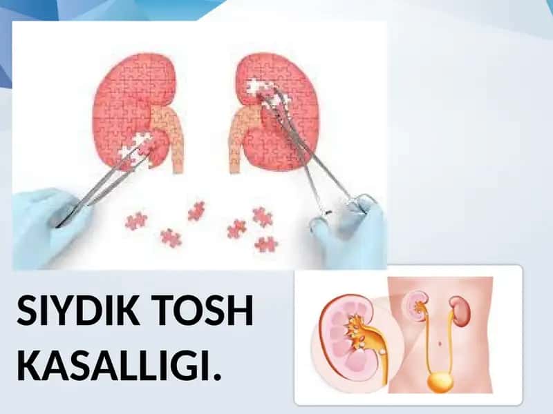 Siydik tosh kasalligi.