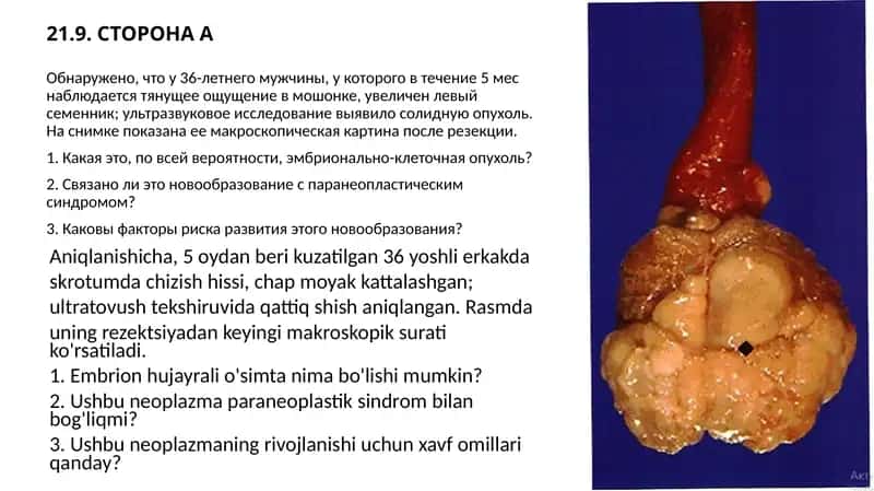Эмбрионально-клеточная опухоль
