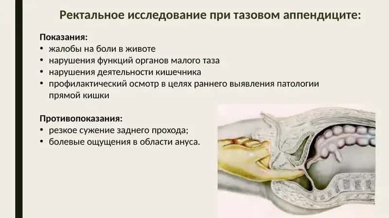 Ректальное исследование при тазовом аппендиците