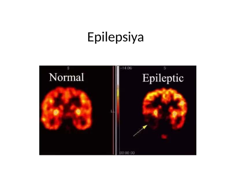 Epilepsiya