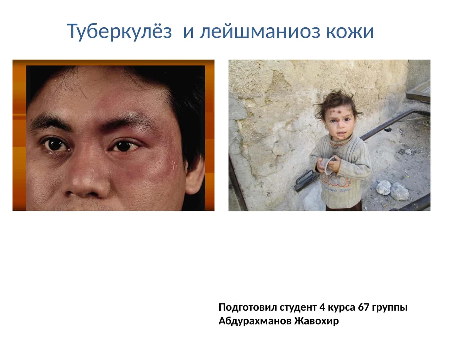 Туберкулёз и лейшманиоз кожи