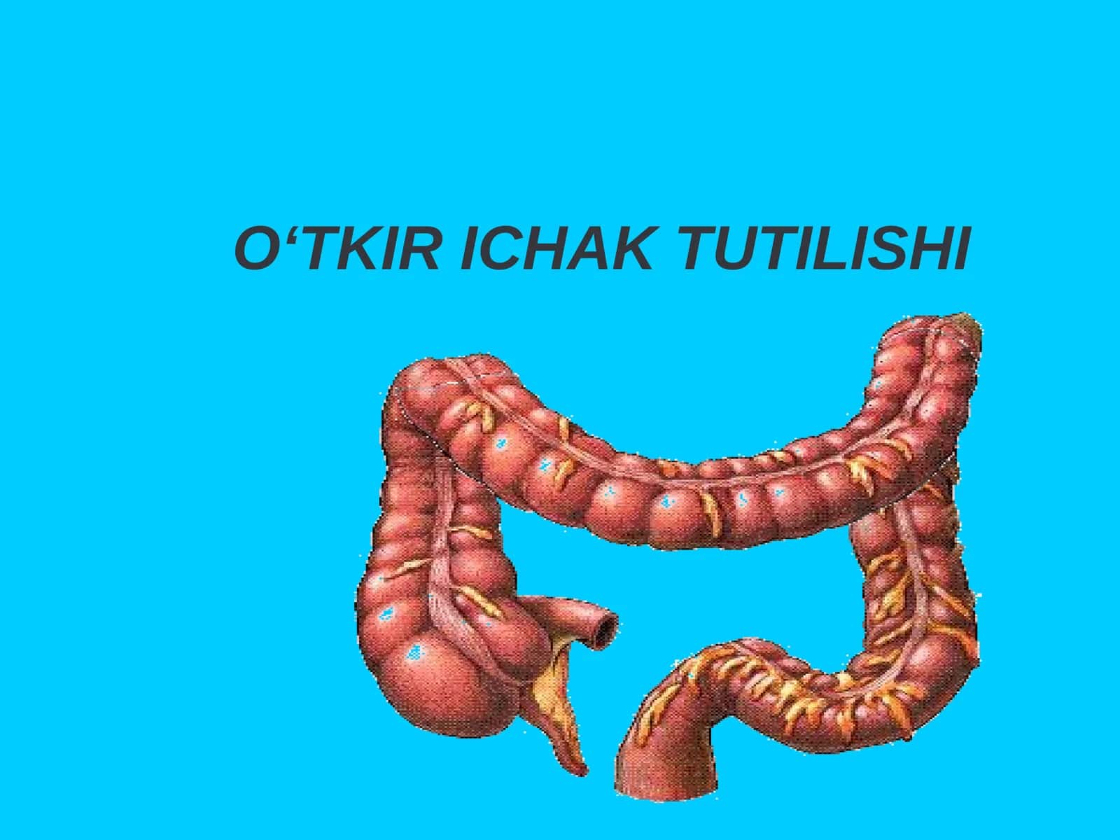 O‘TKIR ICHAK TUTILISHI
